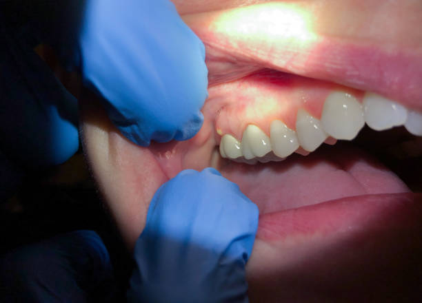 Best Emergency Treatment for Toothache in Coopersburg, PA