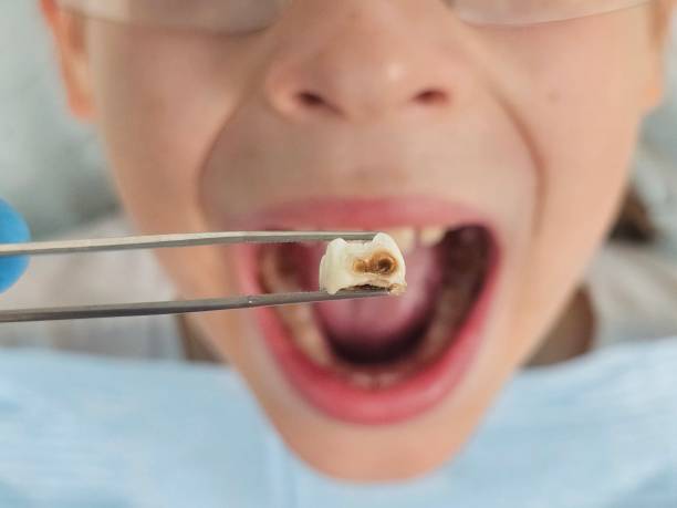 Best Emergency Root Canal Treatment in Coopersburg, PA